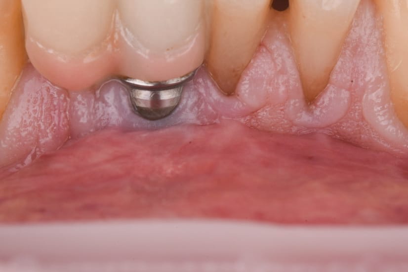 Peri-implant soft tissue recession