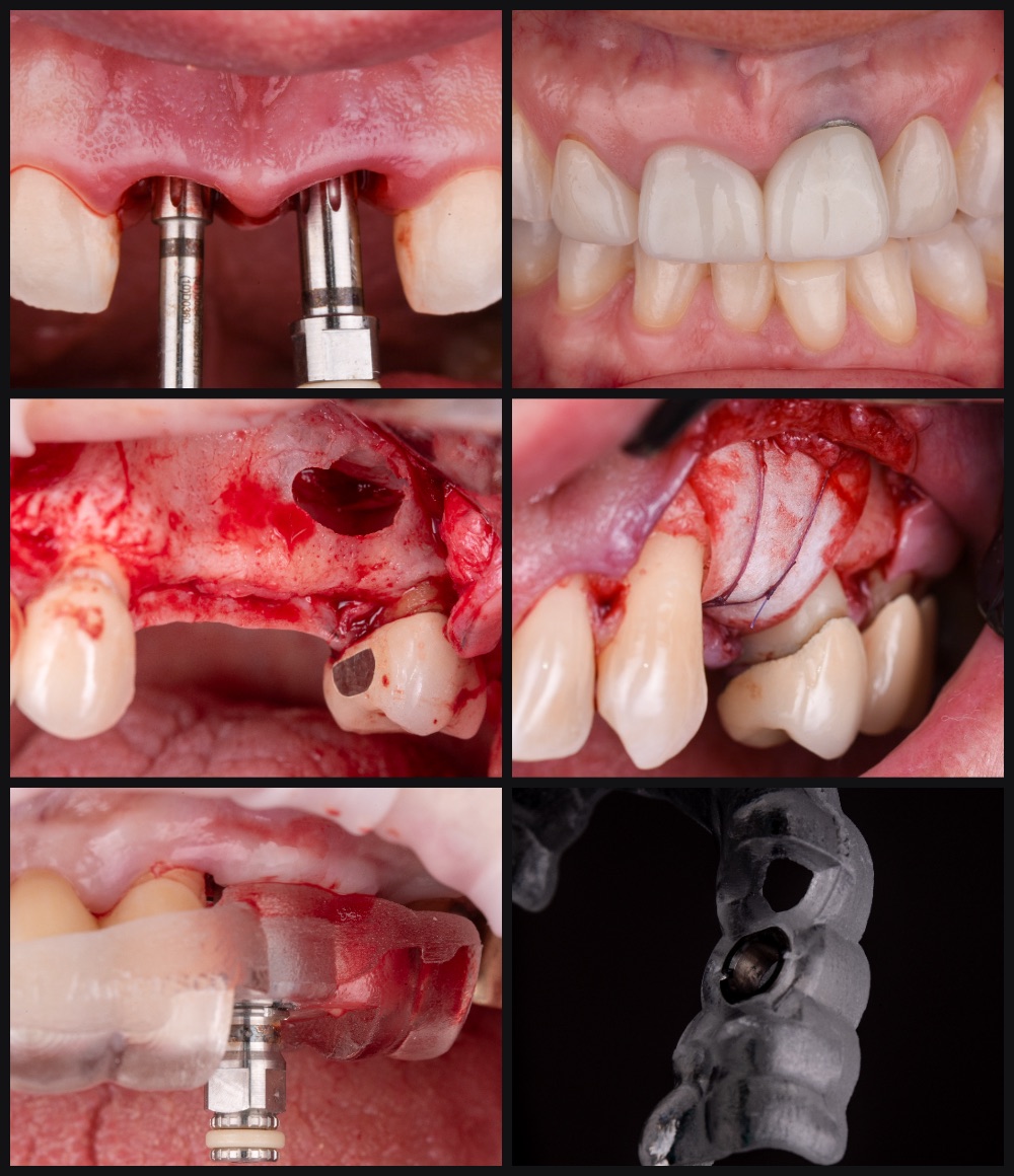 Six-panel clinical sequence of adjacent immediate implants in the maxillary anterior — from surgical placement and grafting through the final restorations