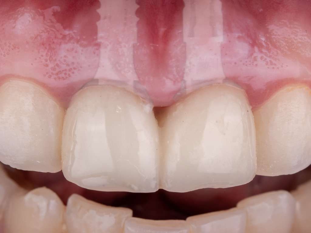Two restored maxillary central incisors with the underlying implant positions ghosted through the tissue, showing a stable midfacial gingival margin
