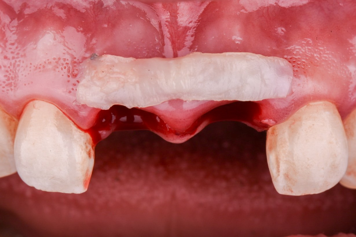 Autogenous connective tissue graft prepared for flapless tunnel delivery across the facial of two adjacent immediate implants