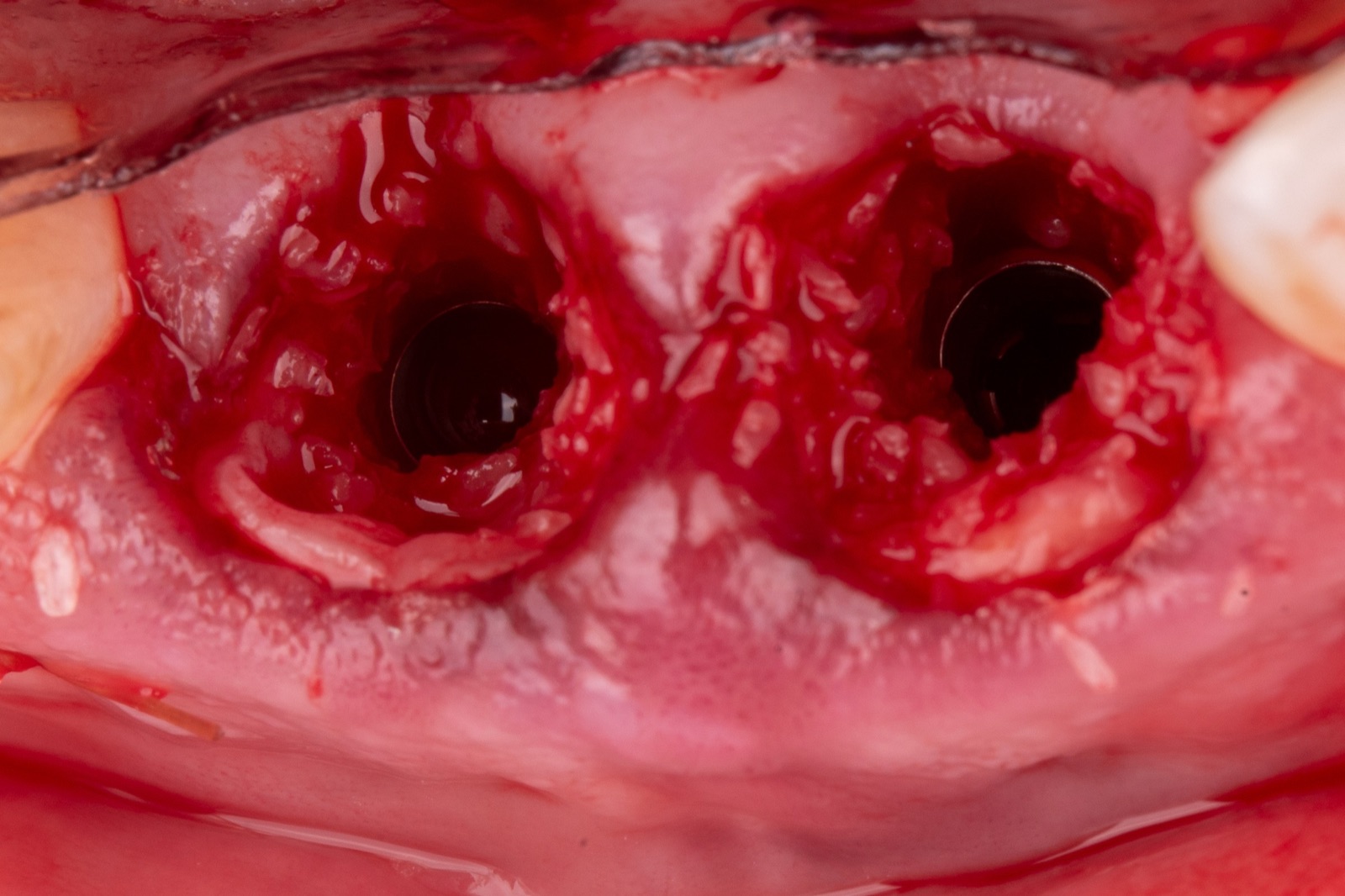 Modified dual-zone grafting: particulate xenograft carried above the crest into the tissue zone around an immediate implant