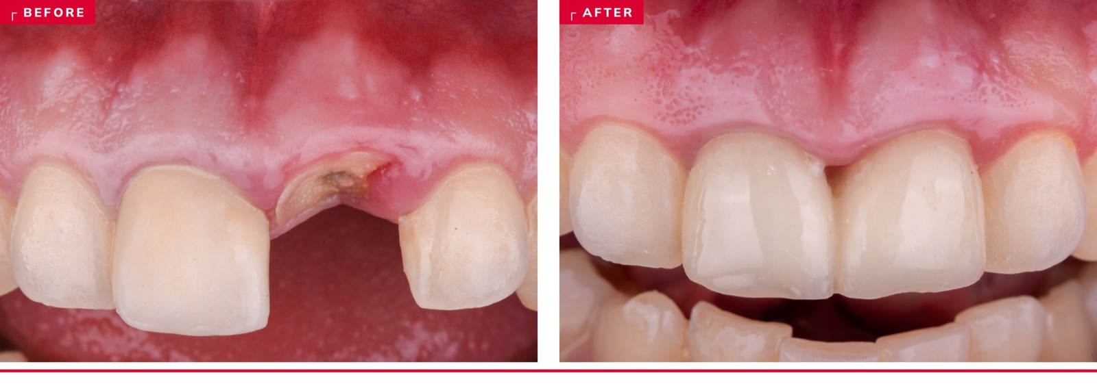 Before and after an immediate implant at a maxillary anterior site — failing root at presentation, restored crown with a stable midfacial margin