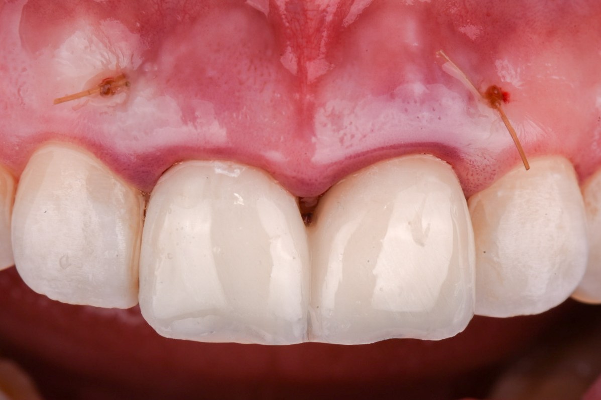 Immediate implant provisional restorations seated out of occlusion with sutures in place