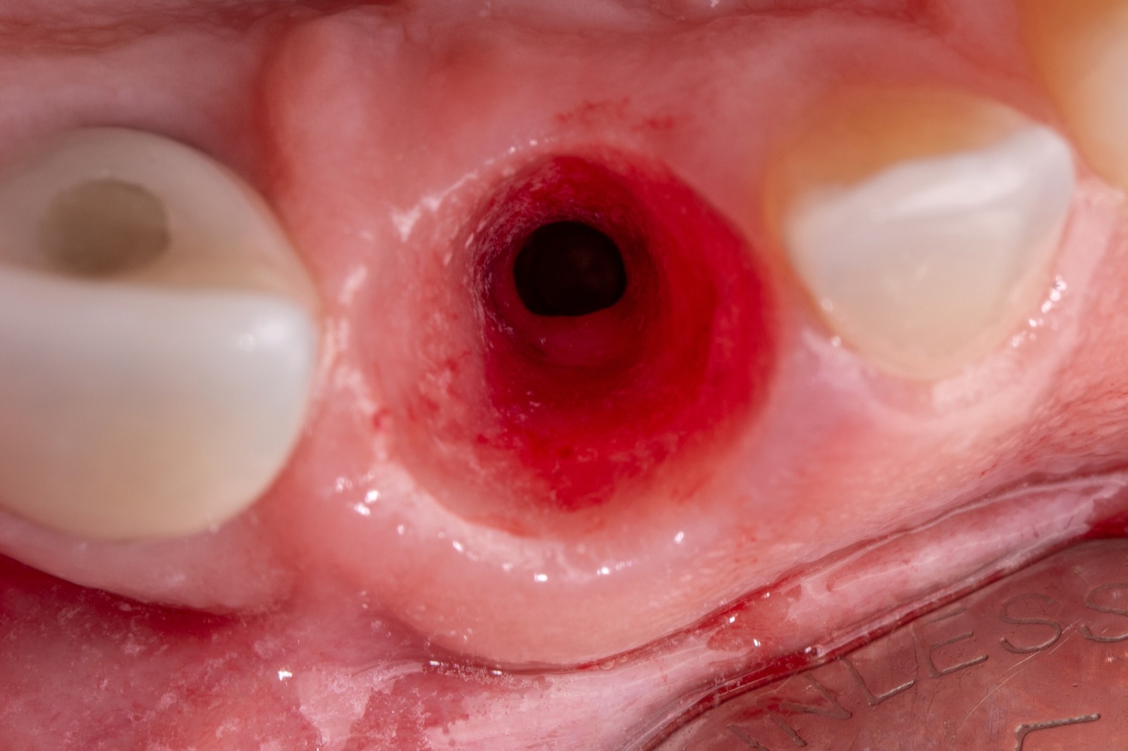 Close-up of an internal socket-shield exposure presenting through the peri-implant sulcus with the restoration removed