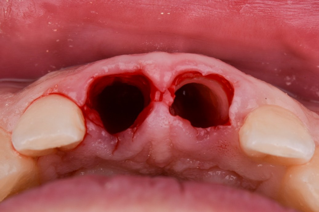 Occlusal view of two adjacent maxillary anterior sockets prepared for immediate implants with retained facial root fragments