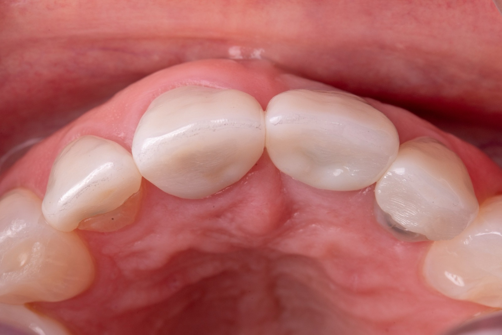 Occlusal view of the maxillary anterior at baseline, showing the implant-supported crown profile relative to the adjacent teeth