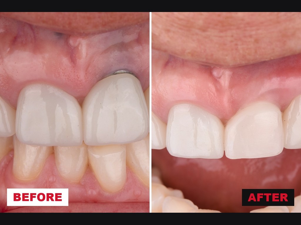 Before and after treatment of a peri-implant soft tissue dehiscence at a maxillary central incisor — an exposed metal collar at presentation, and the margin restored level with the contralateral tooth