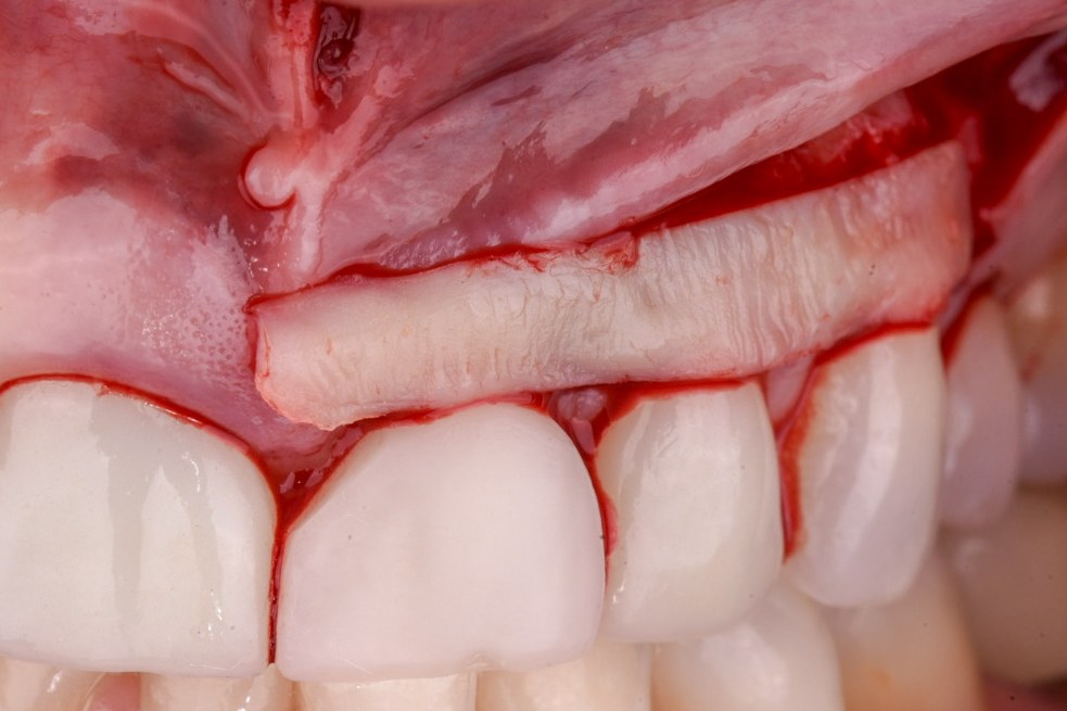 De-epithelialized connective tissue graft sutured over the implant abutment at the level of the contralateral central incisor's gingival margin