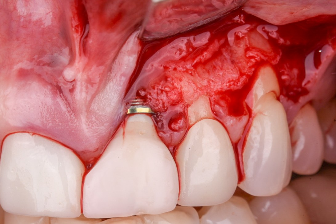 Trapezoidal flap elevated to expose the reduced implant abutment before coronal advancement