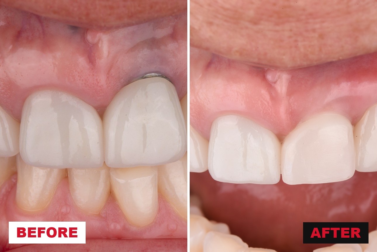 Before and after treatment of a peri-implant soft tissue dehiscence at a maxillary left central incisor — an apically positioned margin with a visible metal collar at presentation, and the same site with the margin restored to the level of the contralateral tooth