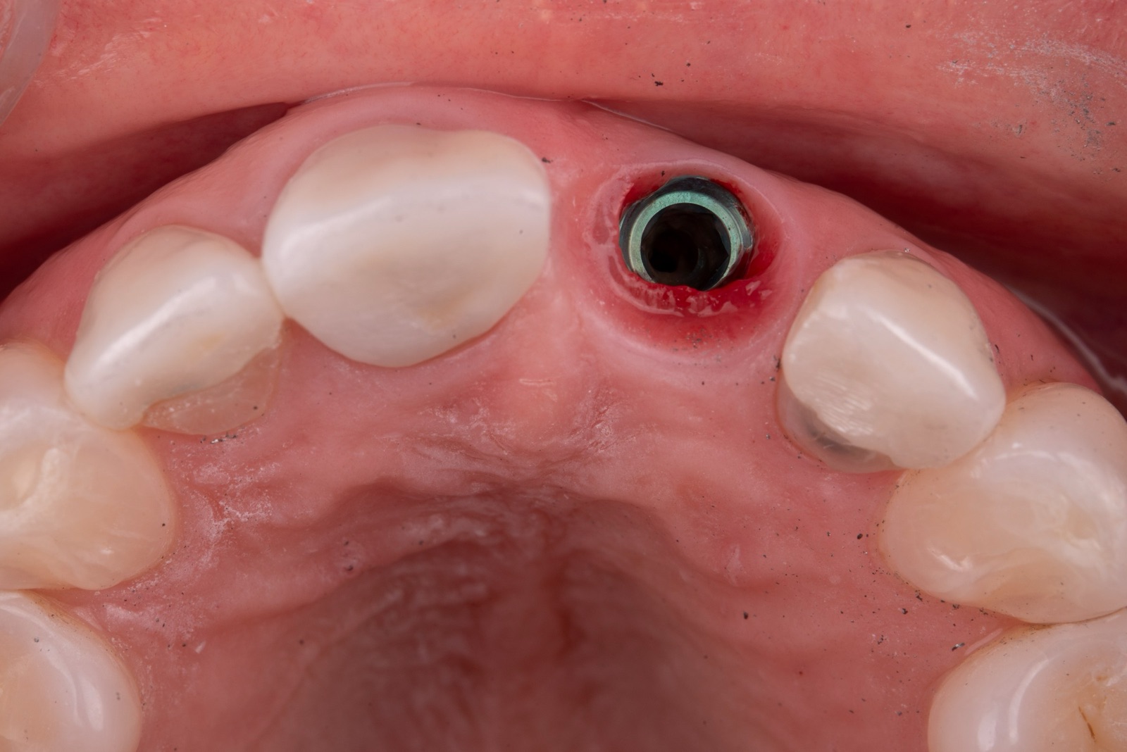 Occlusal view of the same site with the crown removed, exposing the implant head relative to the line connecting the adjacent gingival margins