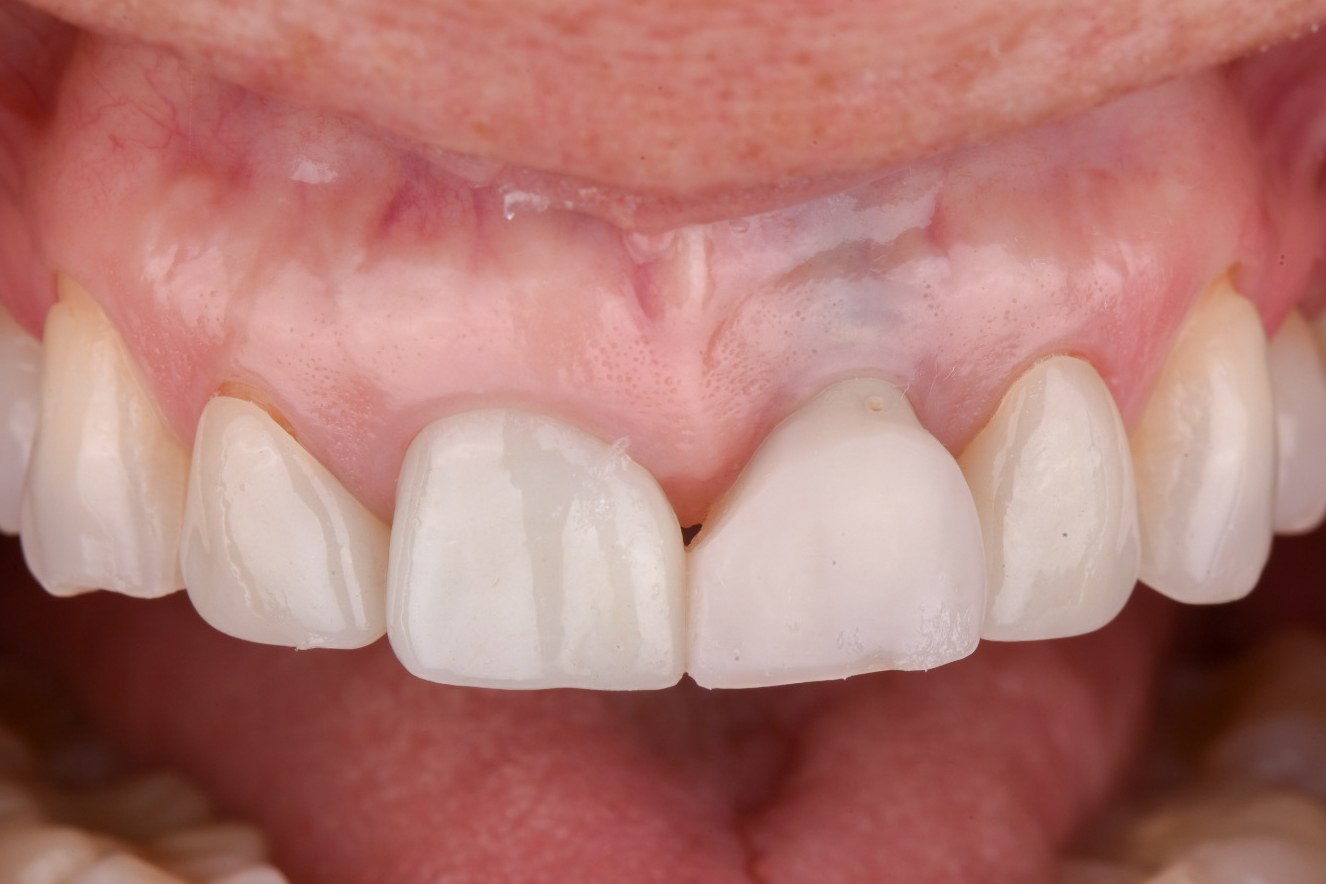 The shortened screw-retained provisional in place at the end of the prosthetic phase, with the interproximal tissue filled in