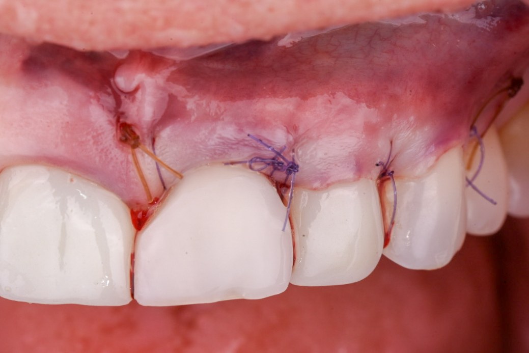 Coronally advanced flap sutured passively over the abutment convexity at the completion of surgery