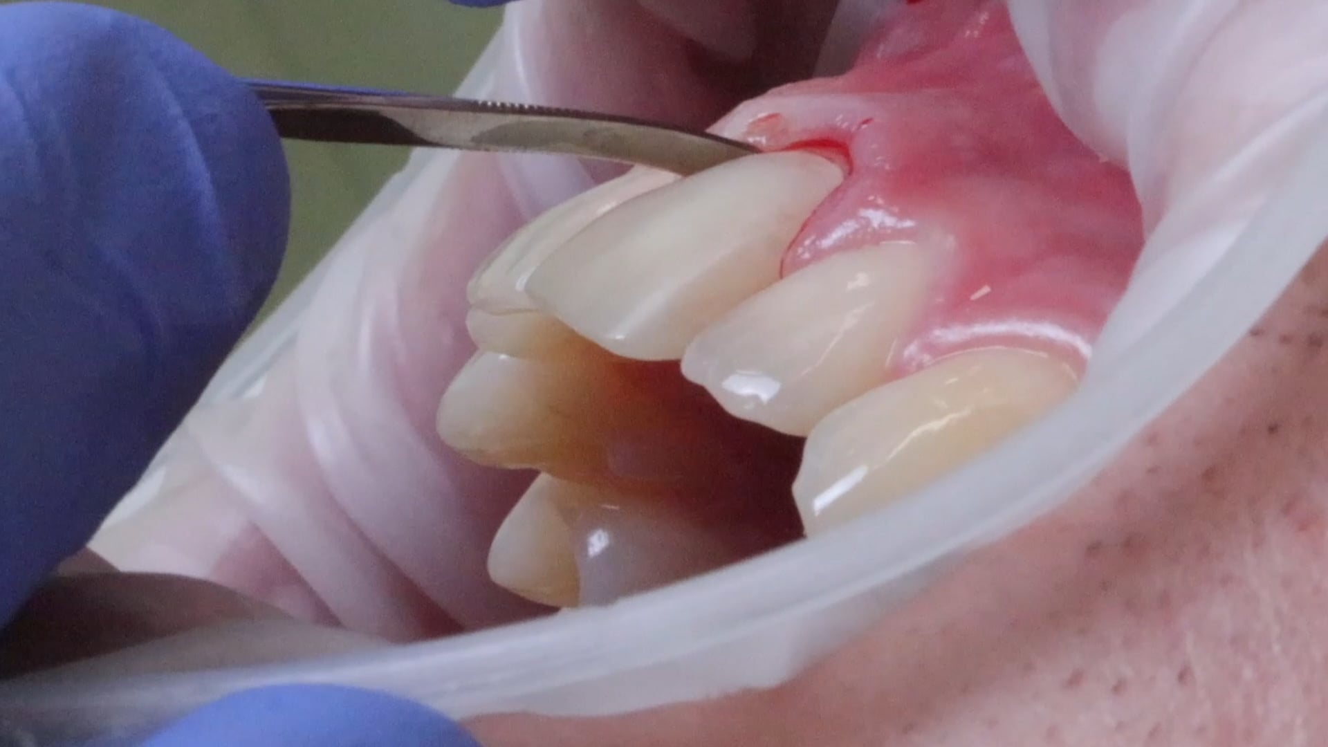 Atraumatic EXT #9