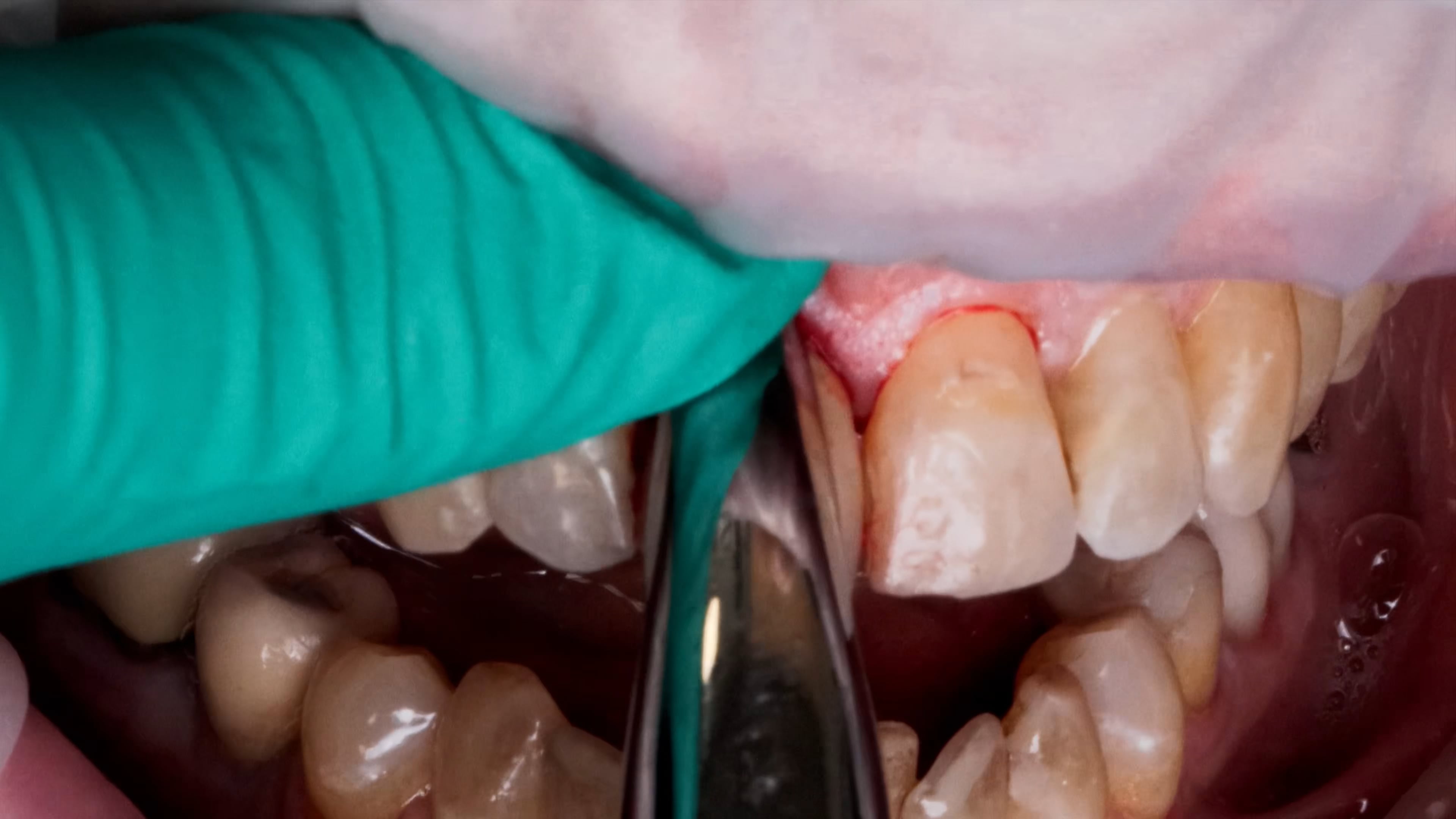 Atraumatic Extraction #8 with Periotomes