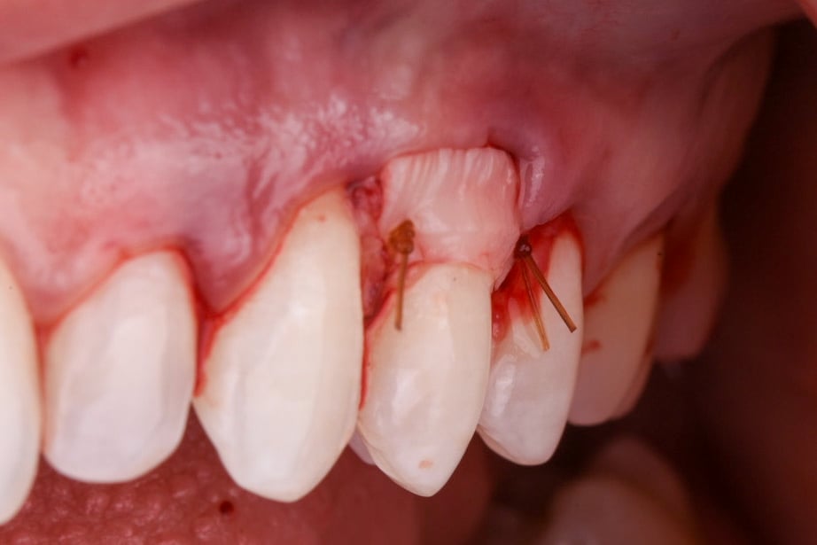 Connective Tissue Graft #12 — Envelope Flap