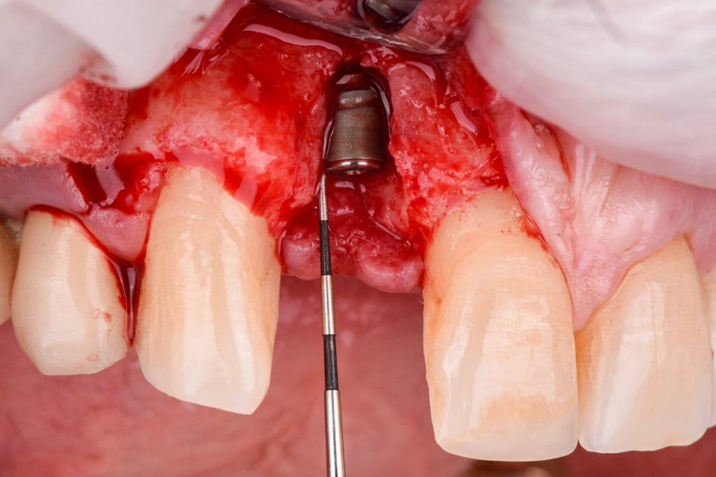 Early Implant #7