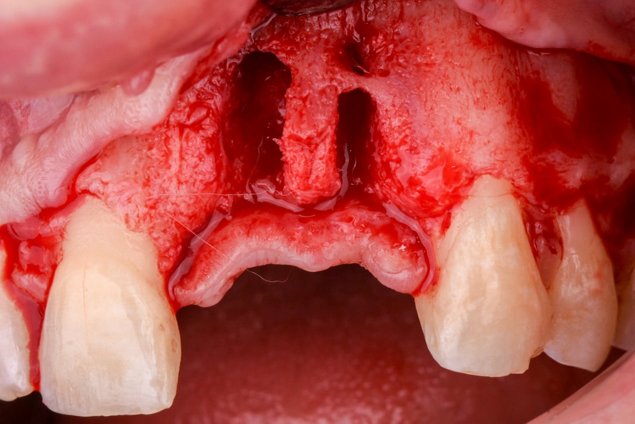 Early Implant Placement #9 & #10 with GBR
