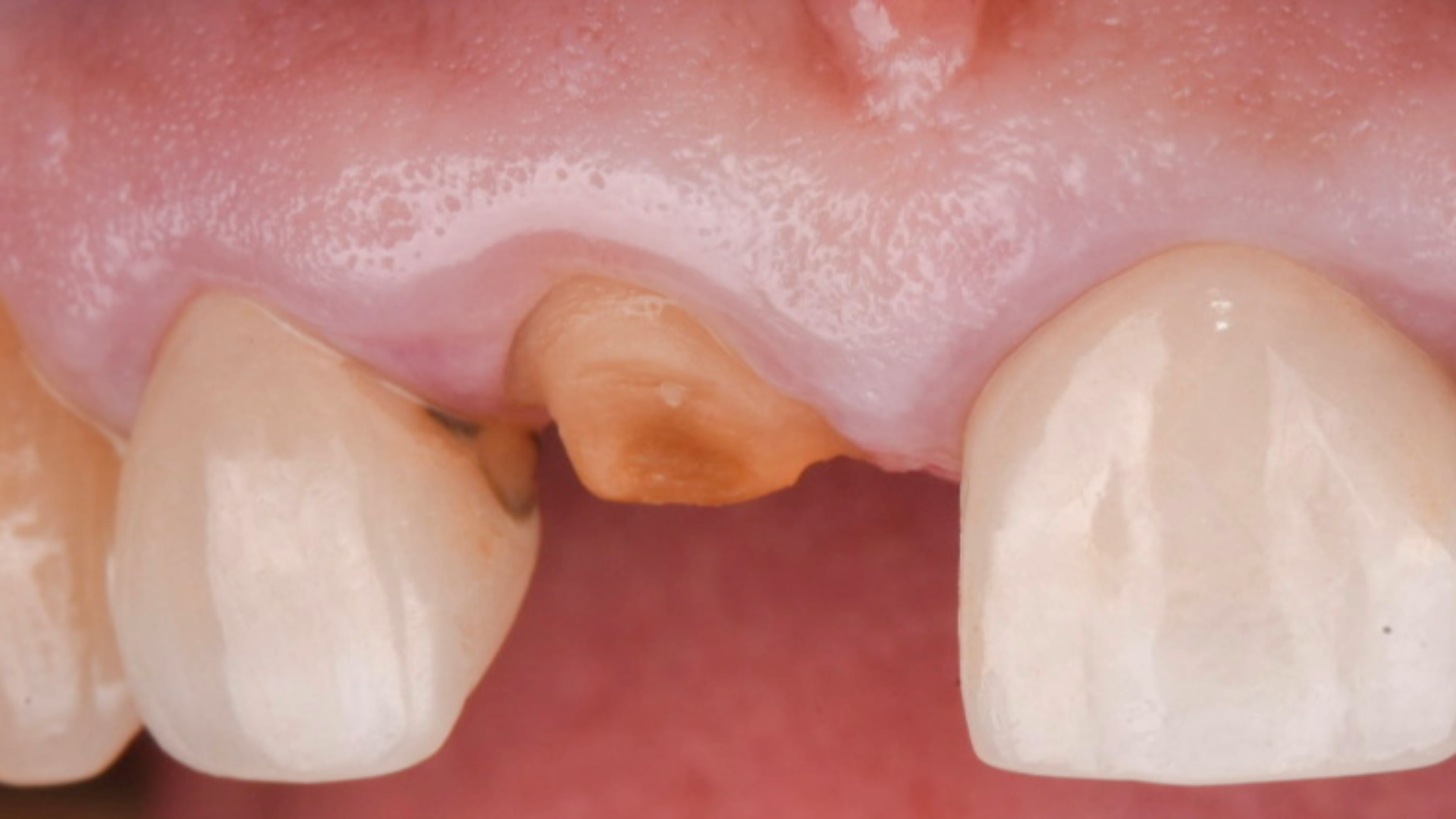 Extraction Portion of Immediate #8