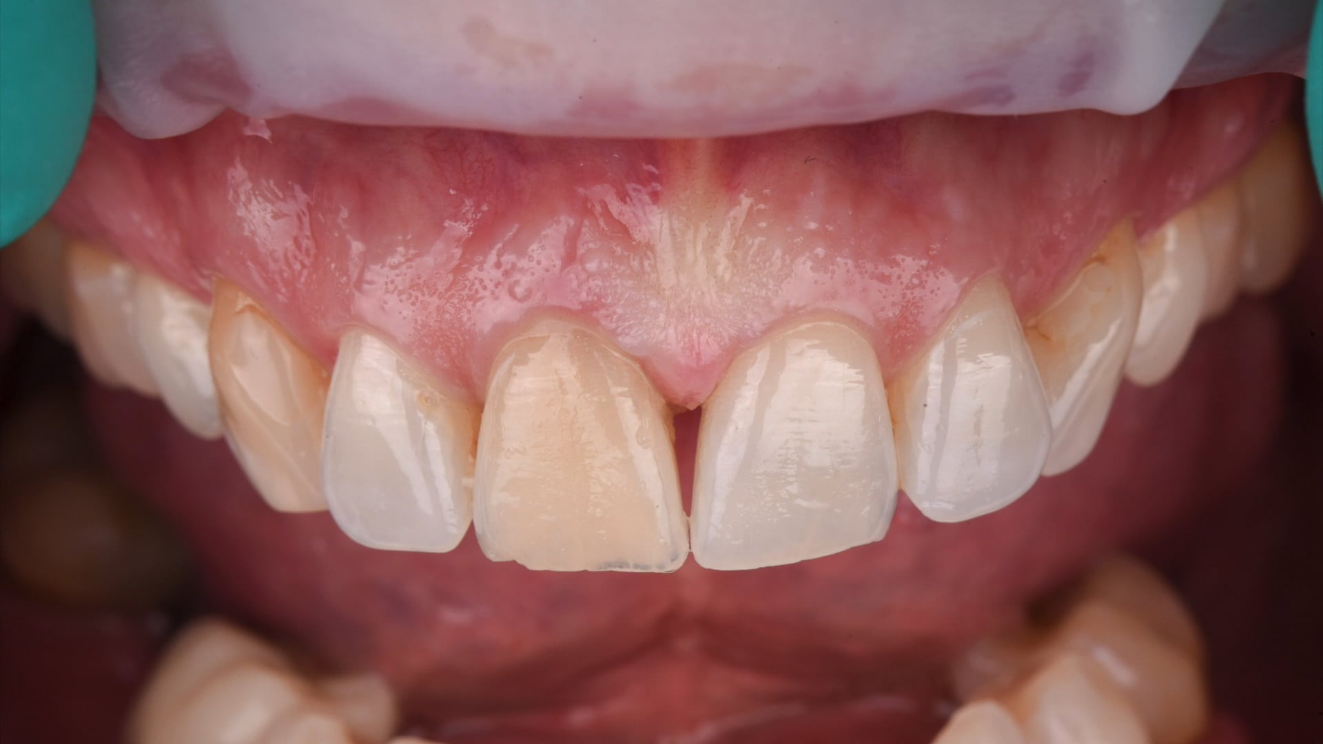 Immediate Implant / Loading with Socket Shield and Connective Tissue Grafting