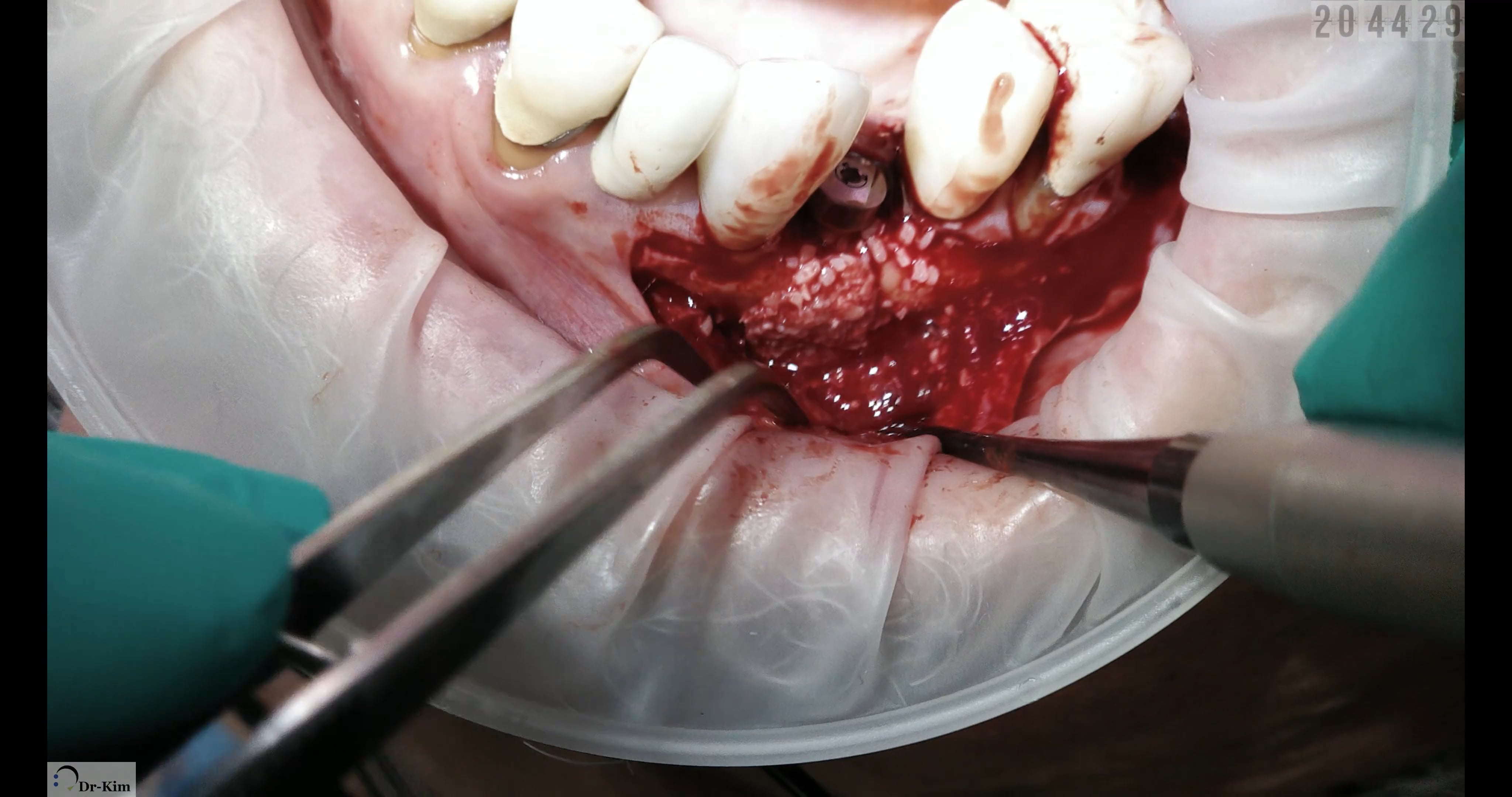 Implant #2 & #5 with GBR