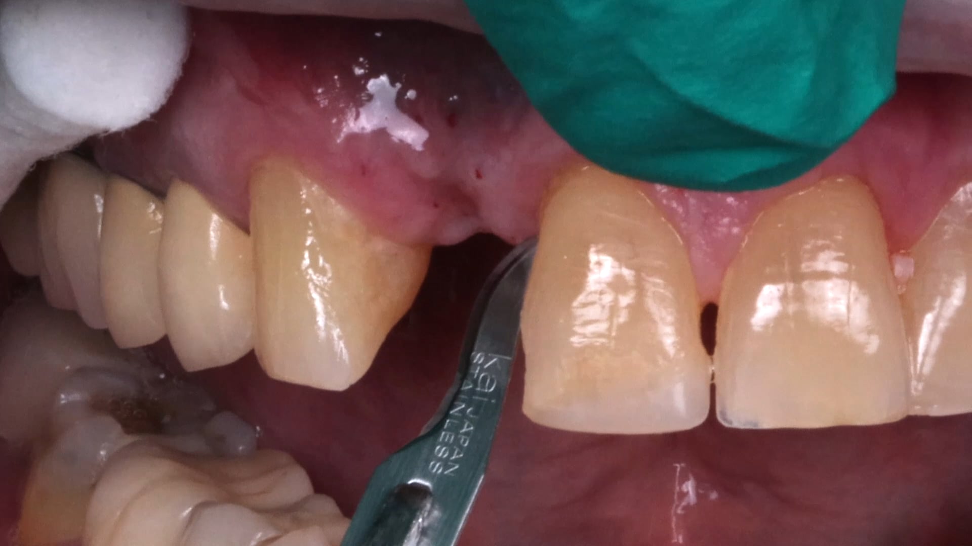 Implant with GBR — 1 Minute Summary