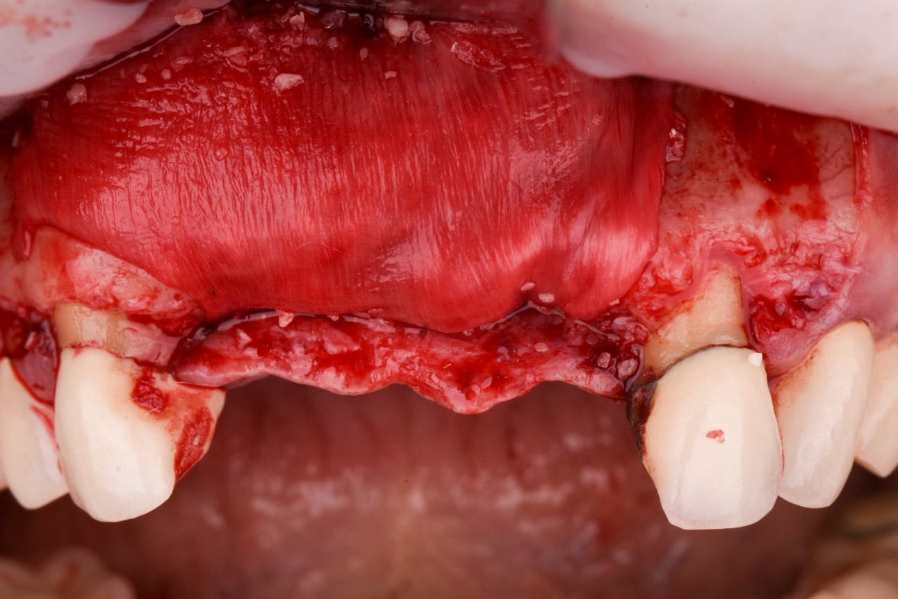 Implants #8 and #9 with GBR