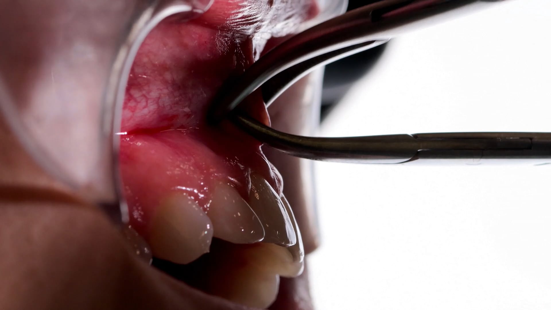 Labial Frenectomy
