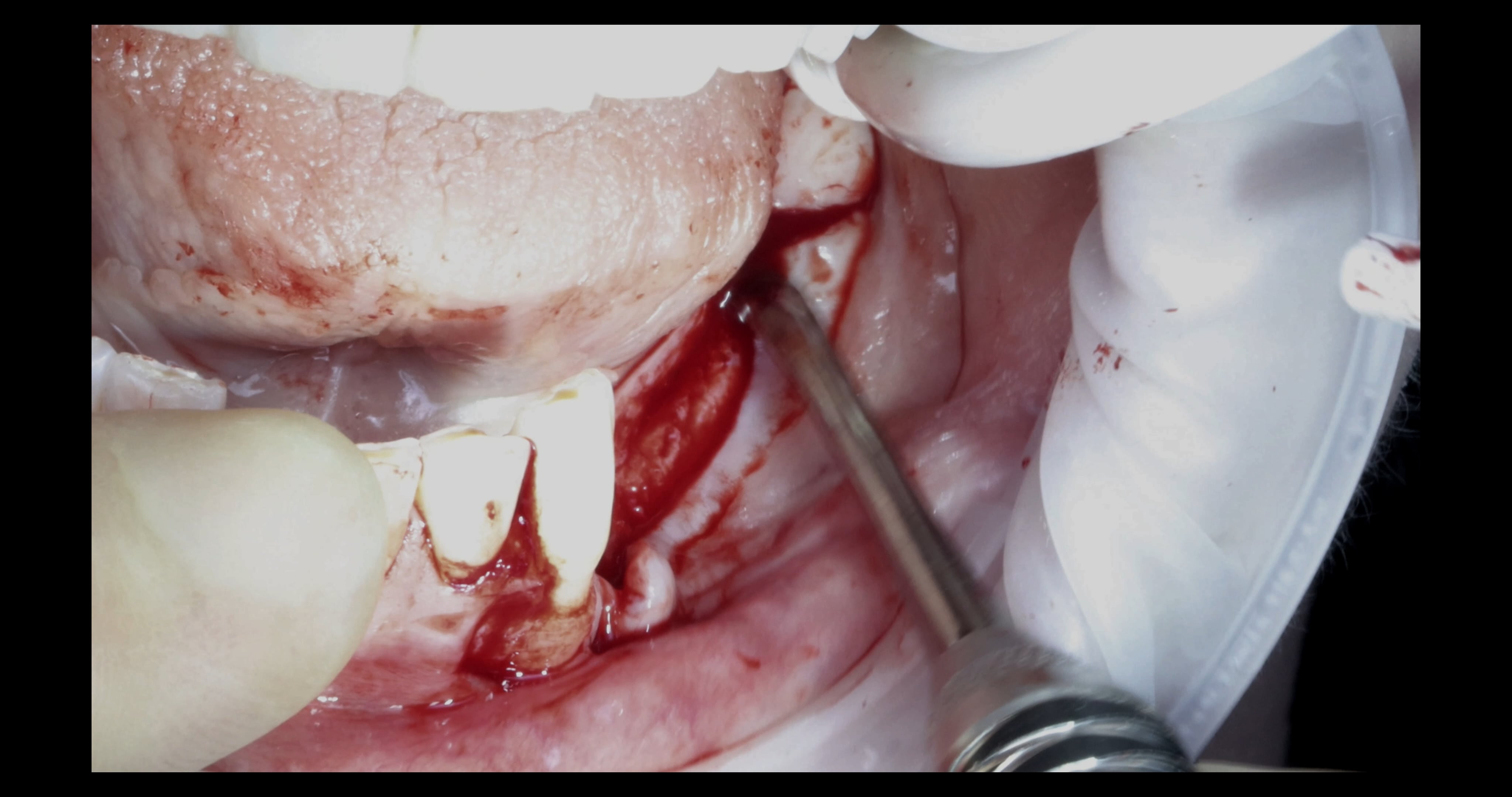 Periosteal Incision & Lingual Flap Release